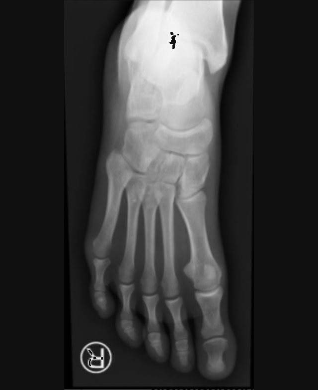 xray of human foot